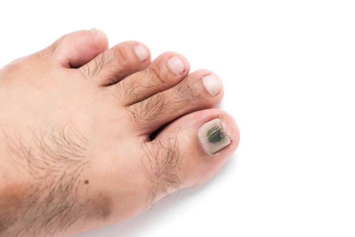 blackened toenails