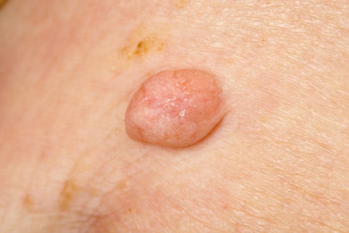 যৌনাঙ্গের warts চিকিত্সা জন্য প্রাকৃতিক উপাদান