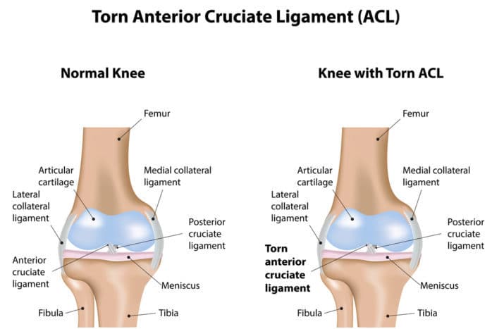 পূর্ববর্তী cruciate অঙ্গরাগ