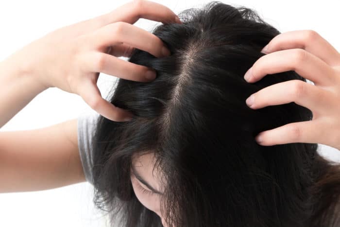 dandruff এবং psoriasis