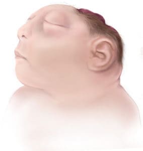 anencephaly প্রতিরোধ