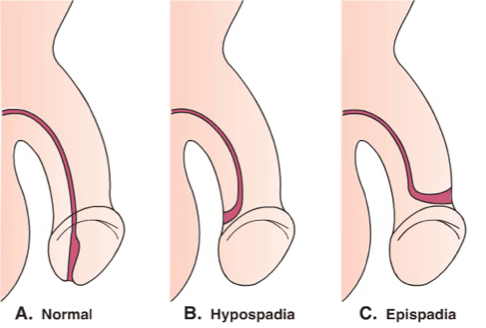 লিঙ্গ গর্ত স্বাভাবিক নয়, hypospadias এর পর্ব