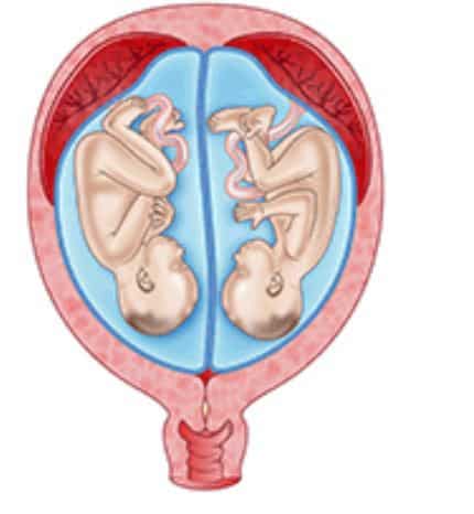 উৎস: http://raisingchildren.net.au/articles/twins_fraternal_and_identical.html/context/1641