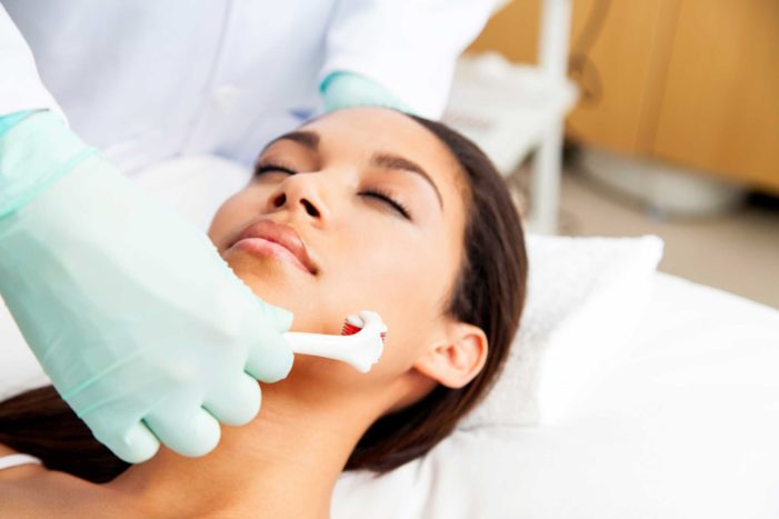 microneedling