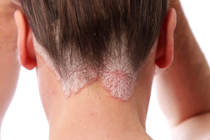 সংক্রামক psoriasis হয় না